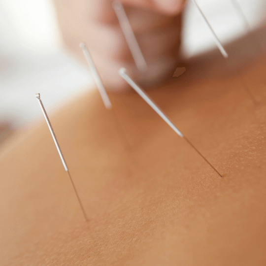treating trauma with acupuncture